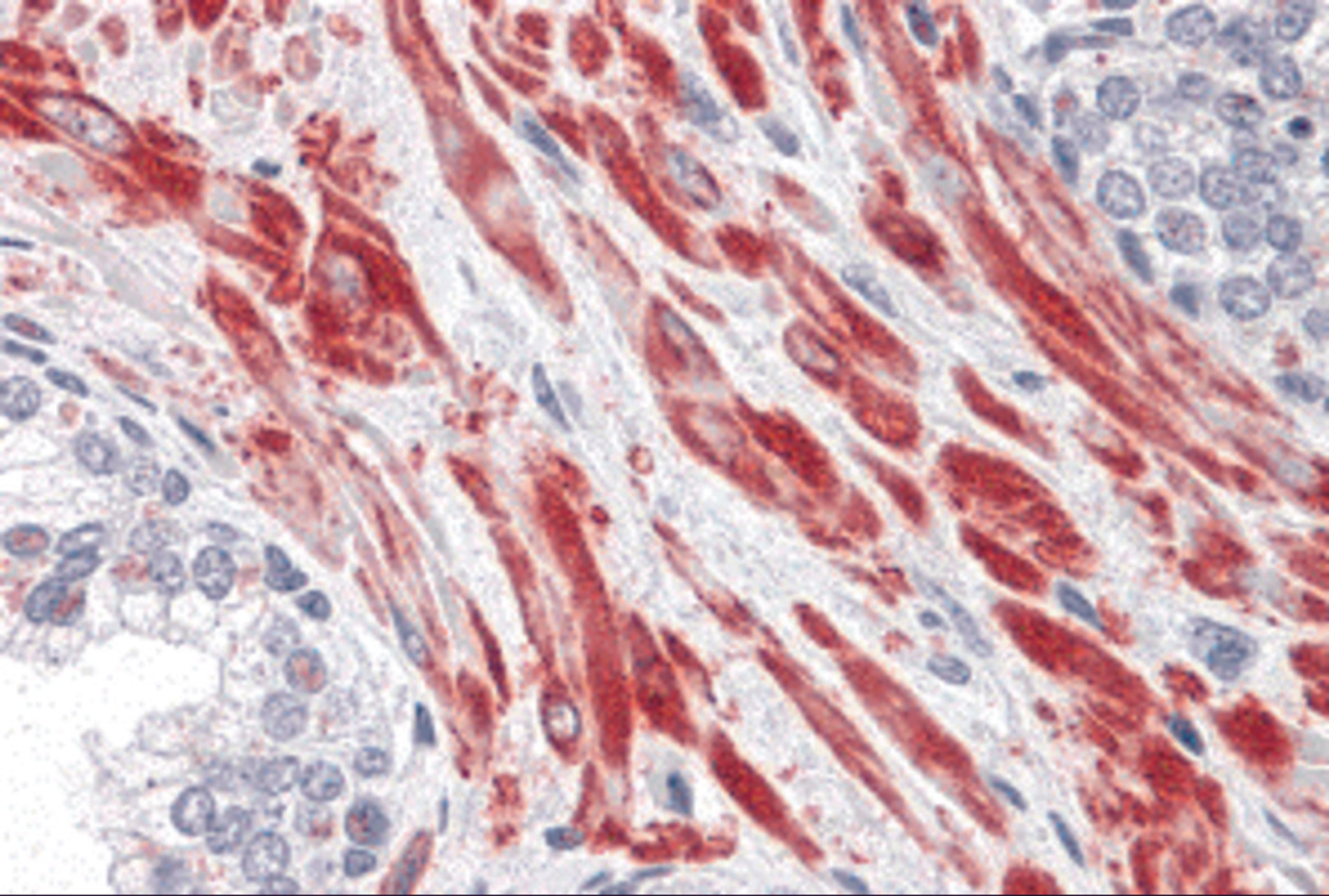 Immunohistochemistry of TBC1D4 in human prostate tissue with TBC1D4 antibody at 10 μg/mL.