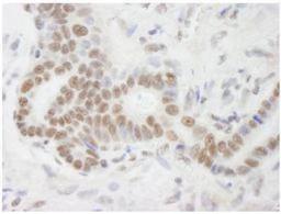 Immunohistochemistry-Paraffin: RNA Helicase A Antibody [NB110-40579] - Detection of Human DHX9 by Immunohistochemistry. Sample: FFPE section of human stomach adenocarcinoma. Antibody: Affinity purified rabbit anti-DHX9 used at a dilution of 1:250. Detection: DAB staining using Immunohistochemistry Accessory Kit