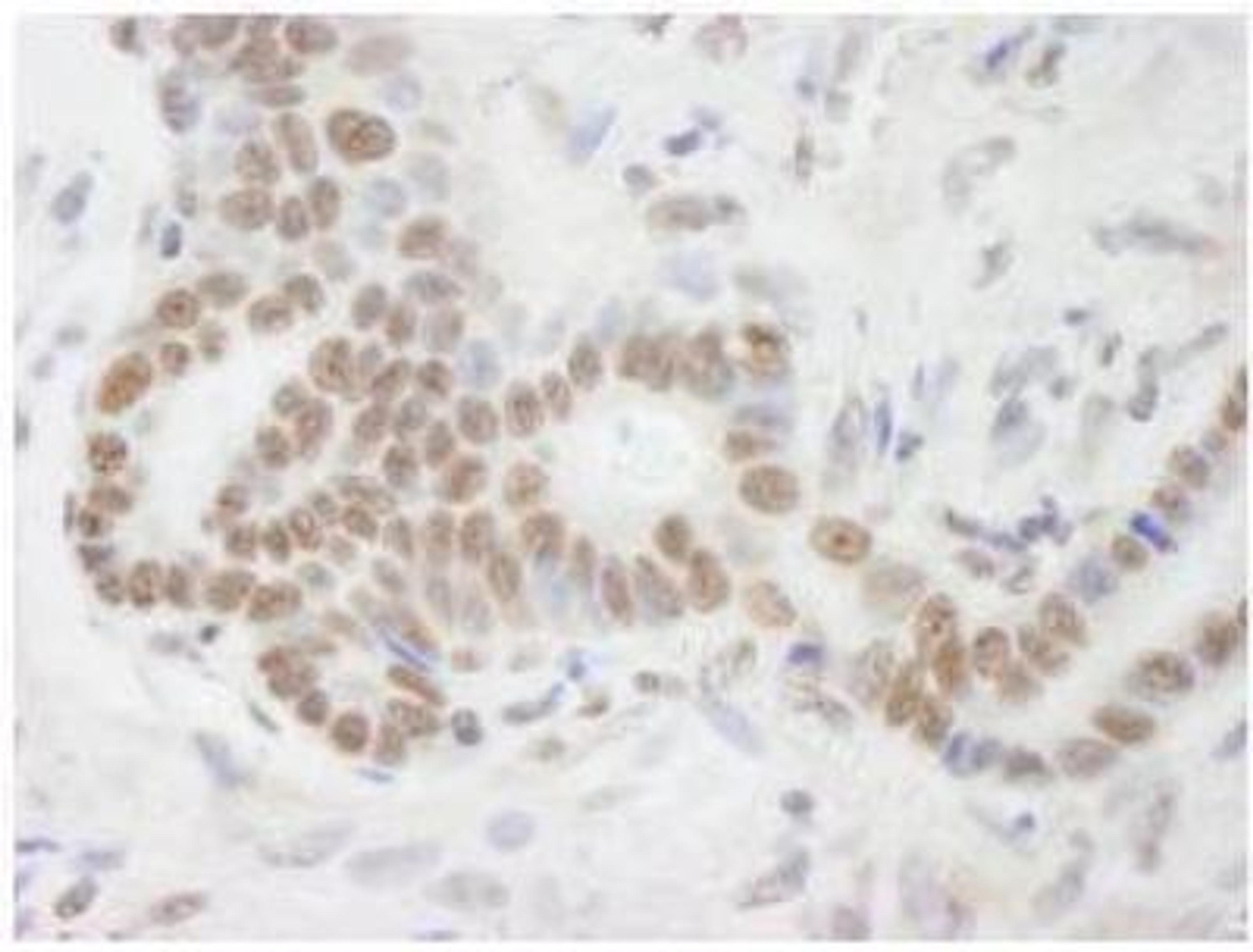 Immunohistochemistry-Paraffin: RNA Helicase A Antibody [NB110-40579] - Detection of Human DHX9 by Immunohistochemistry. Sample: FFPE section of human stomach adenocarcinoma. Antibody: Affinity purified rabbit anti-DHX9 used at a dilution of 1:250. Detection: DAB staining using Immunohistochemistry Accessory Kit