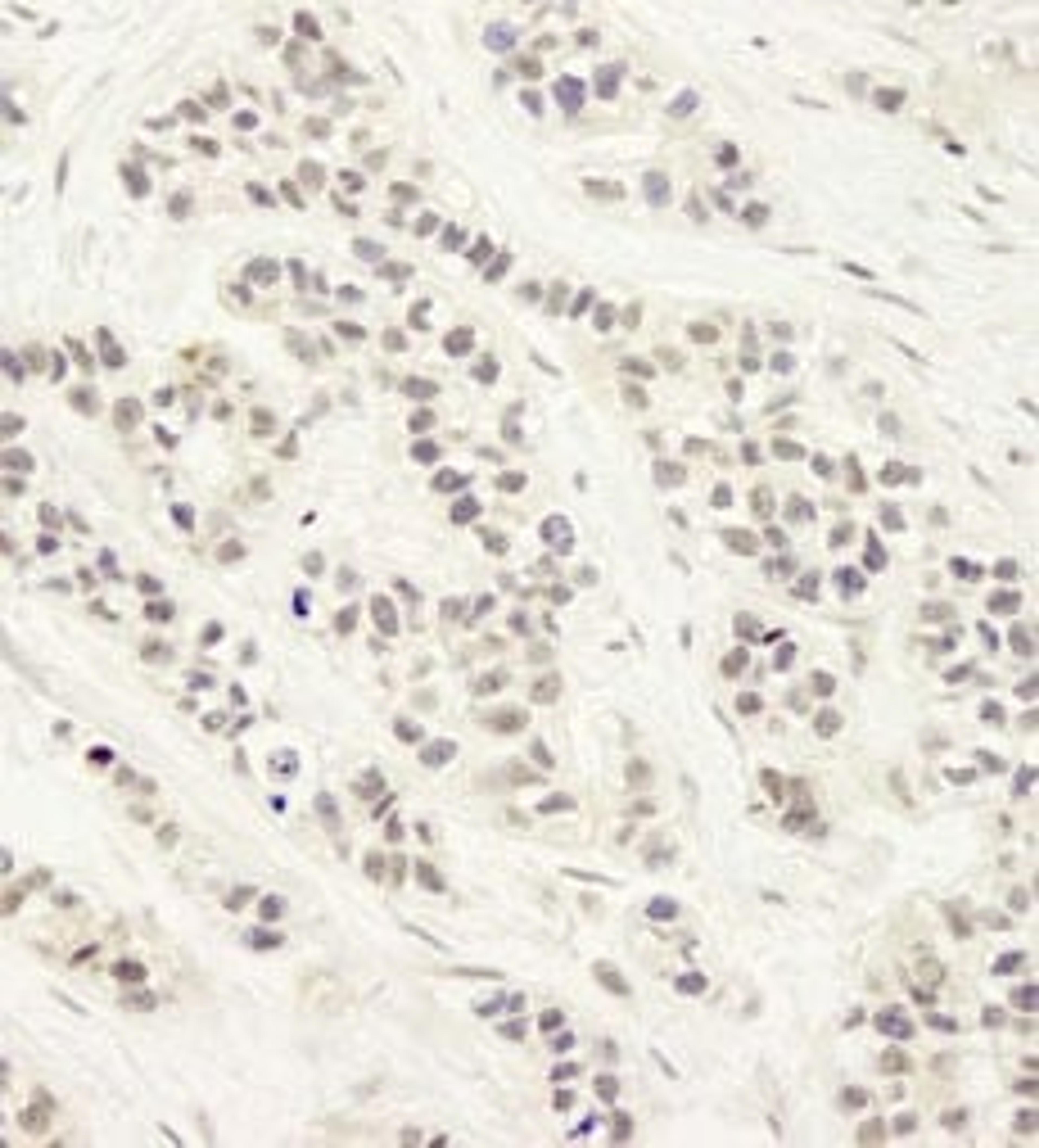 Detection of human Artemis by immunohistochemistry.