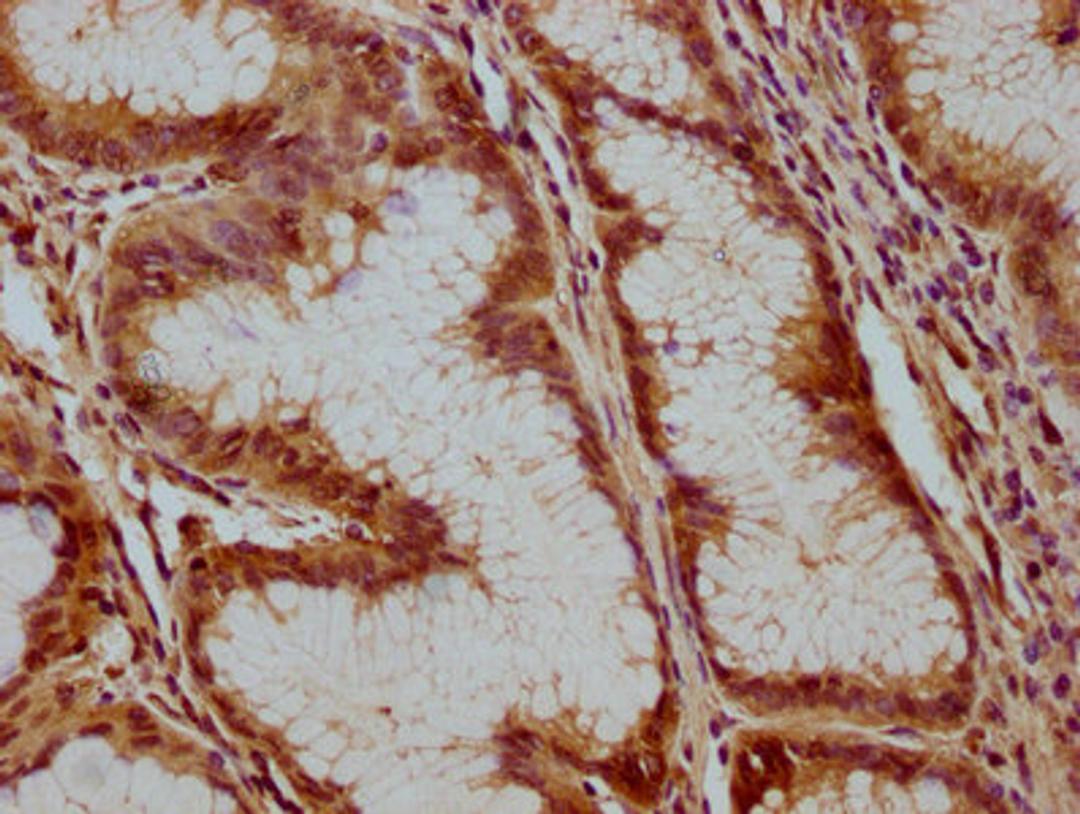 IHC image of CSB-PA002399LA01HU diluted at 1:100 and staining in paraffin-embedded human gastric cancer performed on a Leica BondTM system. After dewaxing and hydration, antigen retrieval was mediated by high pressure in a citrate buffer (pH 6.0). Section was blocked with 10% normal goat serum 30min at RT. Then primary antibody (1% BSA) was incubated at 4°C overnight. The primary is detected by a biotinylated secondary antibody and visualized using an HRP conjugated SP system.