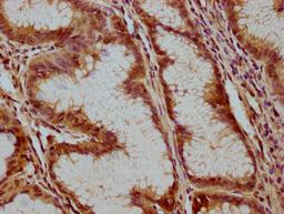 IHC image of CSB-PA002399LA01HU diluted at 1:100 and staining in paraffin-embedded human gastric cancer performed on a Leica BondTM system. After dewaxing and hydration, antigen retrieval was mediated by high pressure in a citrate buffer (pH 6.0). Section was blocked with 10% normal goat serum 30min at RT. Then primary antibody (1% BSA) was incubated at 4°C overnight. The primary is detected by a biotinylated secondary antibody and visualized using an HRP conjugated SP system.