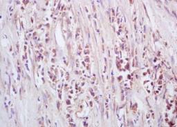 Immunohistochemical analysis of formalin-fixed paraffin embedded human rectal carcinoma tissue using GTSE1 antibody (dilution at 1:200)