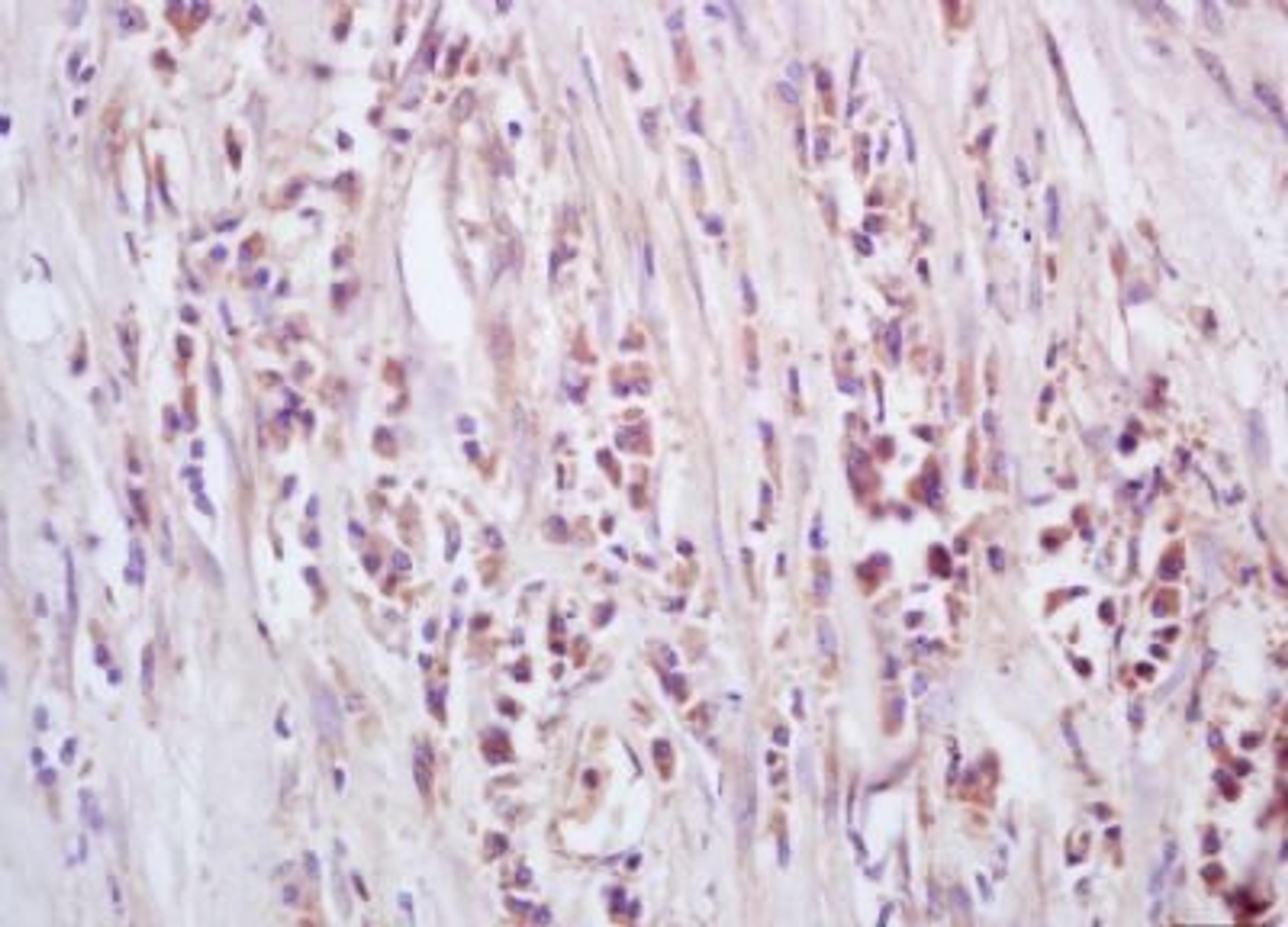 Immunohistochemical analysis of formalin-fixed paraffin embedded human rectal carcinoma tissue using GTSE1 antibody (dilution at 1:200)