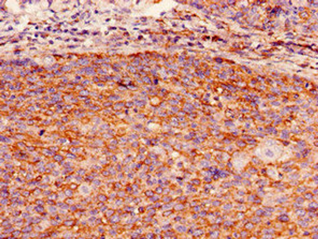 Immunohistochemistry of paraffin-embedded human pancreatic cancer using CSB-PA009298LA01HU at dilution of 1:100