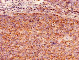 Immunohistochemistry of paraffin-embedded human pancreatic cancer using CSB-PA009298LA01HU at dilution of 1:100