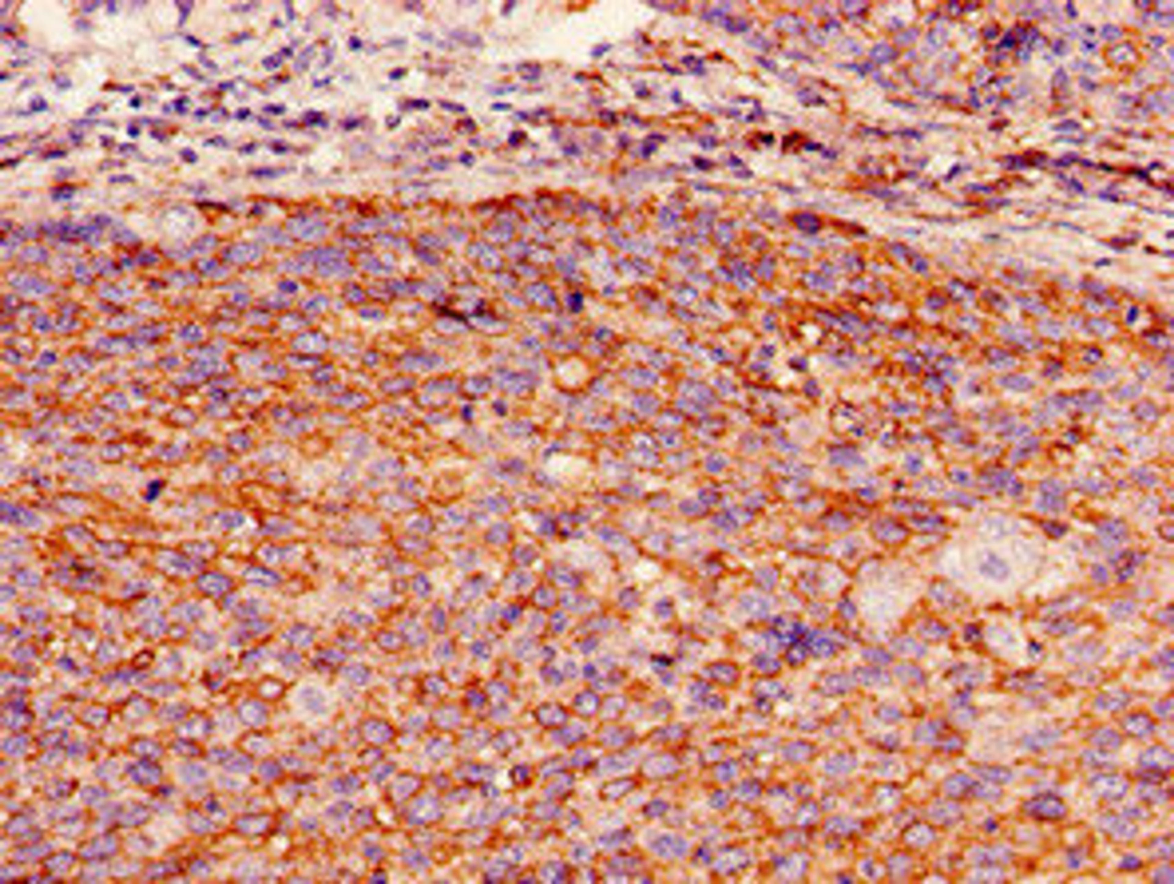Immunohistochemistry of paraffin-embedded human pancreatic cancer using CSB-PA009298LA01HU at dilution of 1:100
