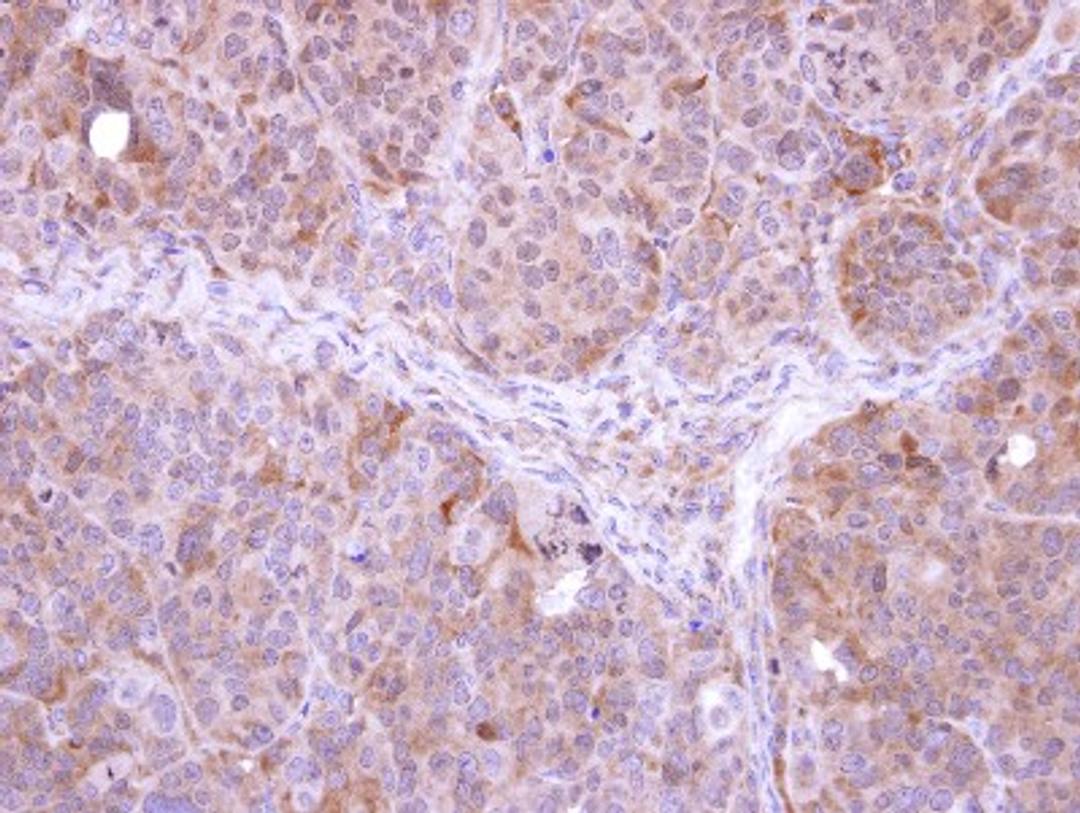 Immunohistochemistry-Paraffin: FbxL12 Antibody [NBP1-31021] - Paraffin-embedded SW480 xenograft, using antibody at 1:500 dilution.