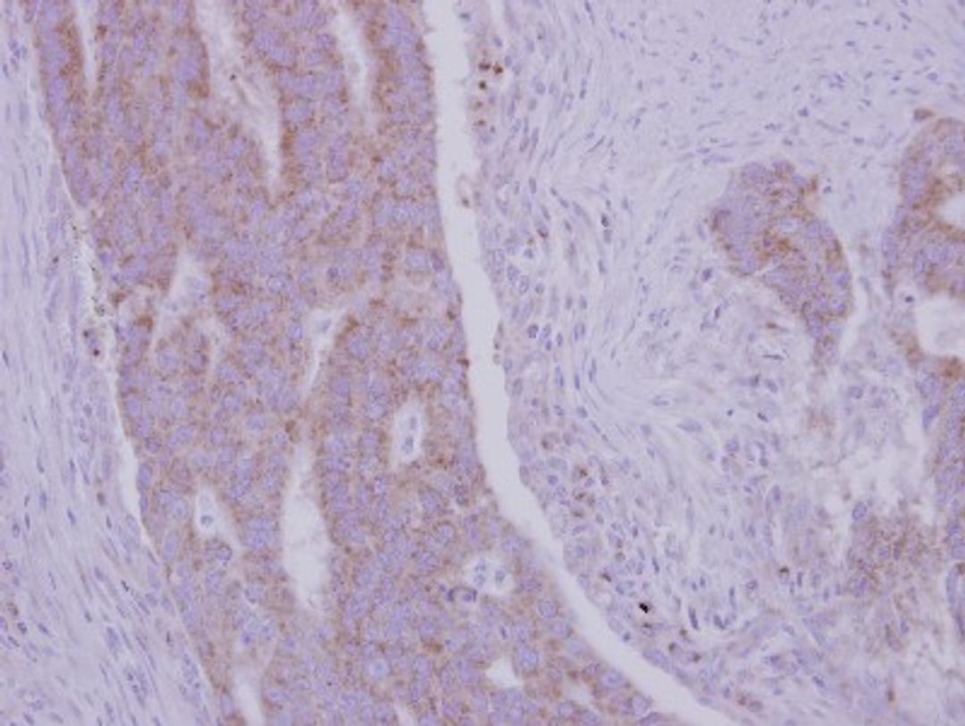 Immunohistochemistry-Paraffin: RRM1 Antibody [NBP2-20231] - Immunohistochemical analysis of paraffin-embedded Colon ca, using antibody at 1:500 dilution.