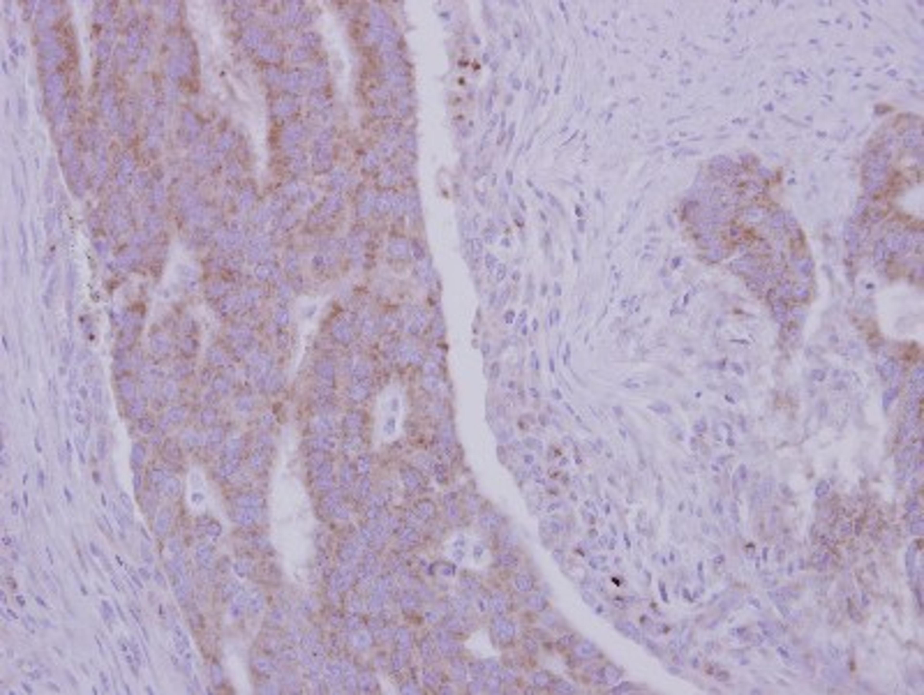 Immunohistochemistry-Paraffin: RRM1 Antibody [NBP2-20231] - Immunohistochemical analysis of paraffin-embedded Colon ca, using antibody at 1:500 dilution.