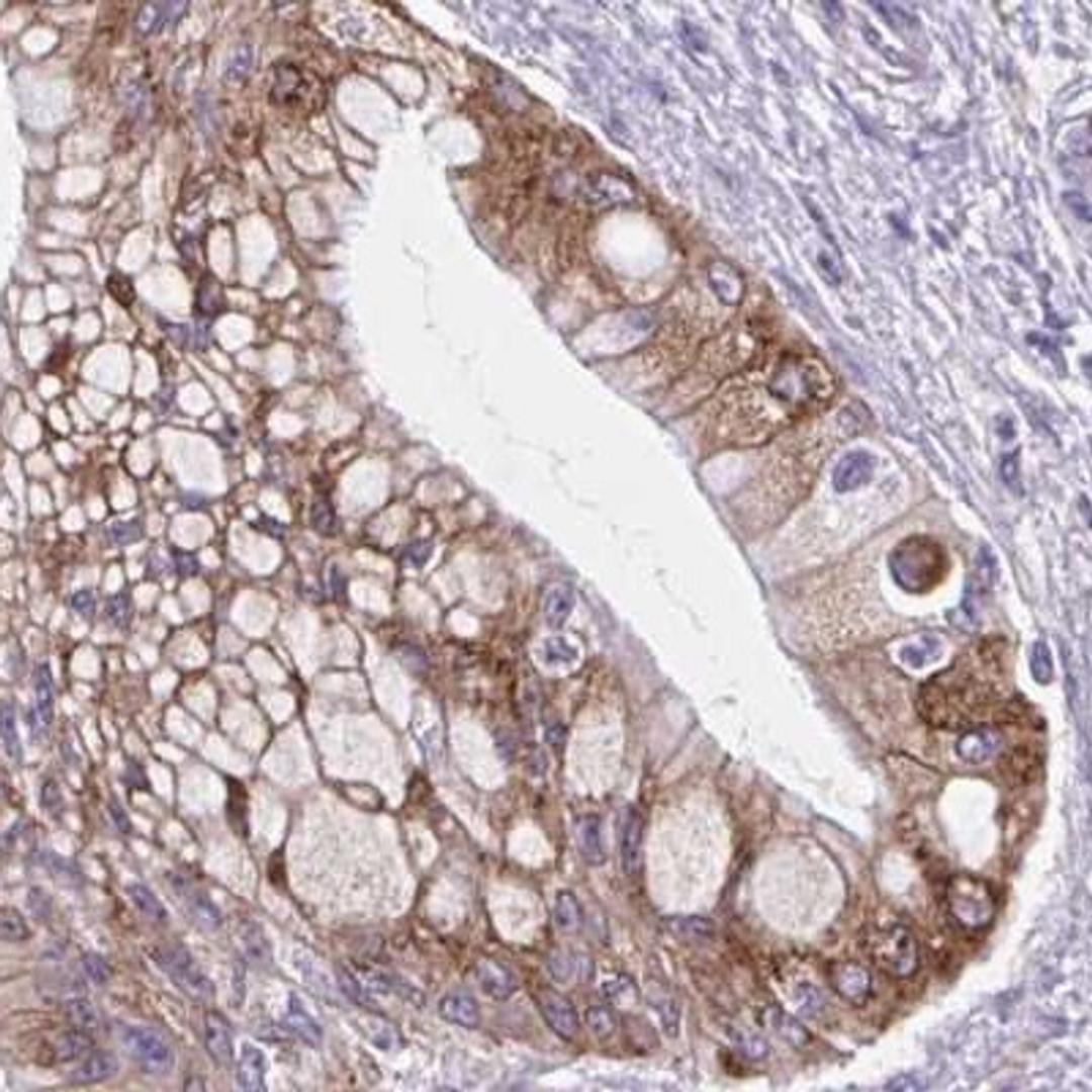 Immunohistochemistry: ADAT3 Antibody [NBP2-31732] - pancreatic cancer