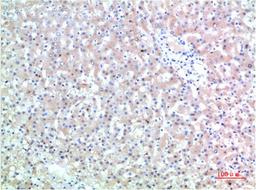 Immunohistochemical analysis of paraffin-embedded Human Liver Carcinoma Tissue using TTR Mouse mAb diluted at 1:200.