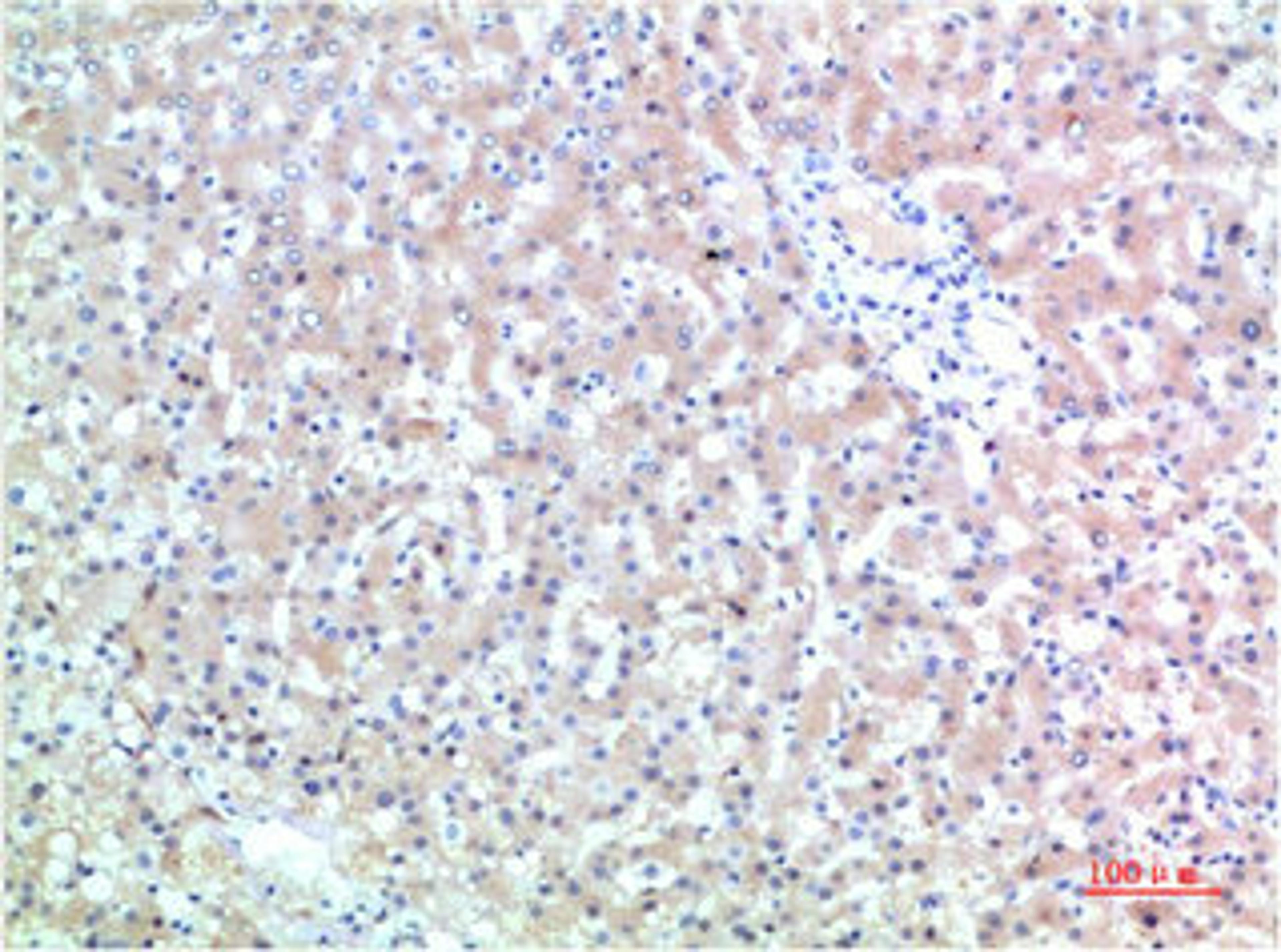 Immunohistochemical analysis of paraffin-embedded Human Liver Carcinoma Tissue using TTR Mouse mAb diluted at 1:200.