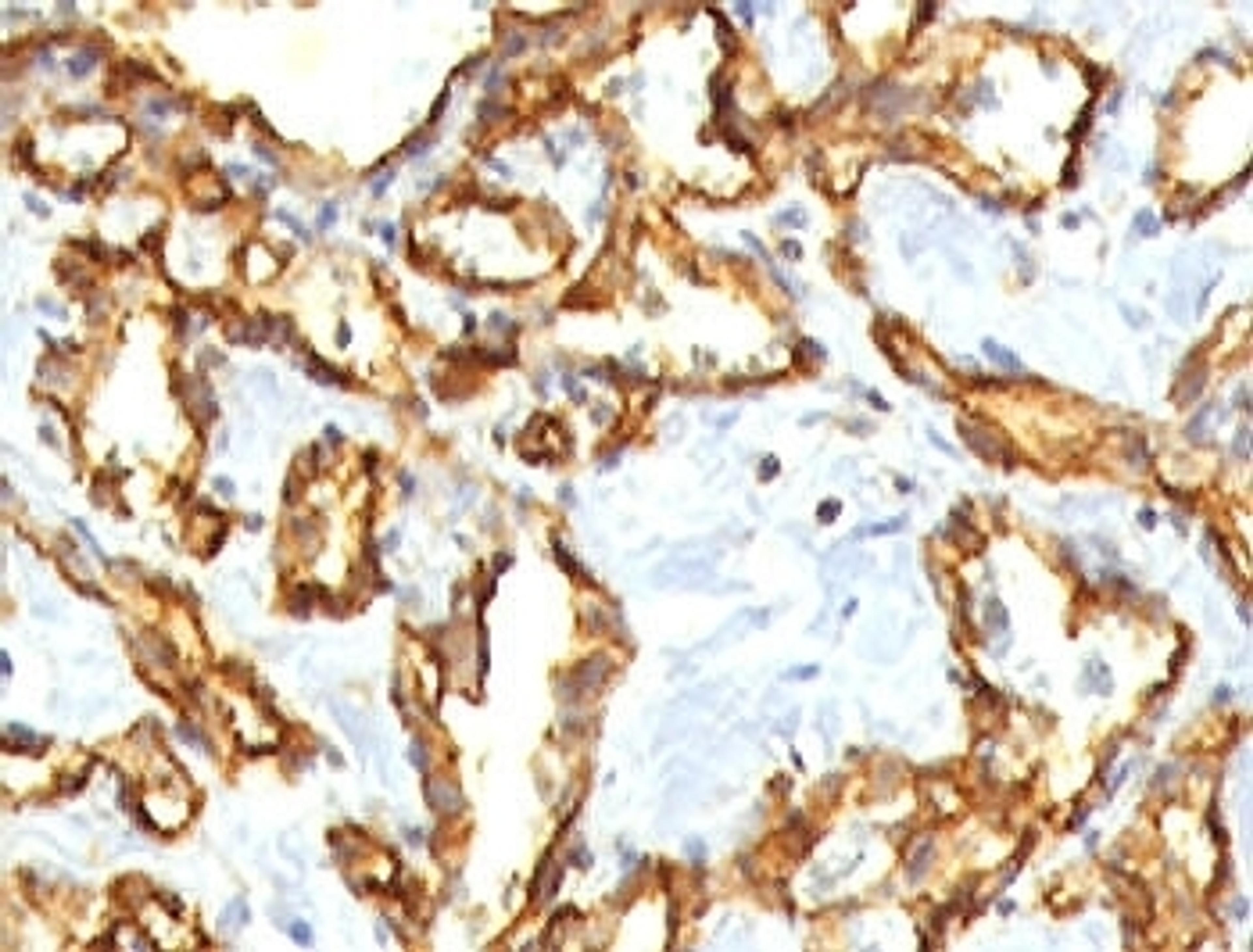 IHC staining of FFPE human angiocarcinoma with CD31 antibody.