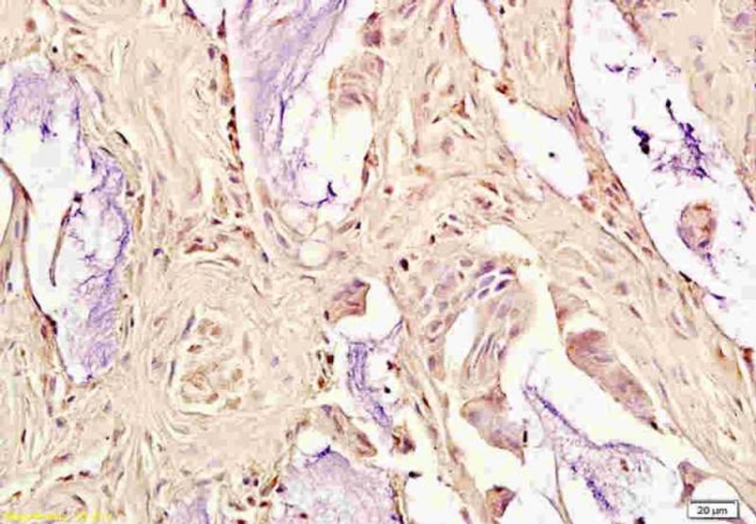 Immunohistochemical staining of paraffin embedded human rectal cancer using OxLDL antibody.