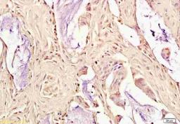 Immunohistochemical staining of paraffin embedded human rectal cancer using OxLDL antibody.