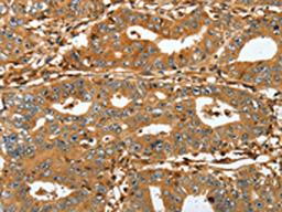 The image on the left is immunohistochemistry of paraffin-embedded Human gastric cancer tissue using CSB-PA968243(RAP1A Antibody) at dilution 1/45, on the right is treated with fusion protein. (Original magnification: ×200)