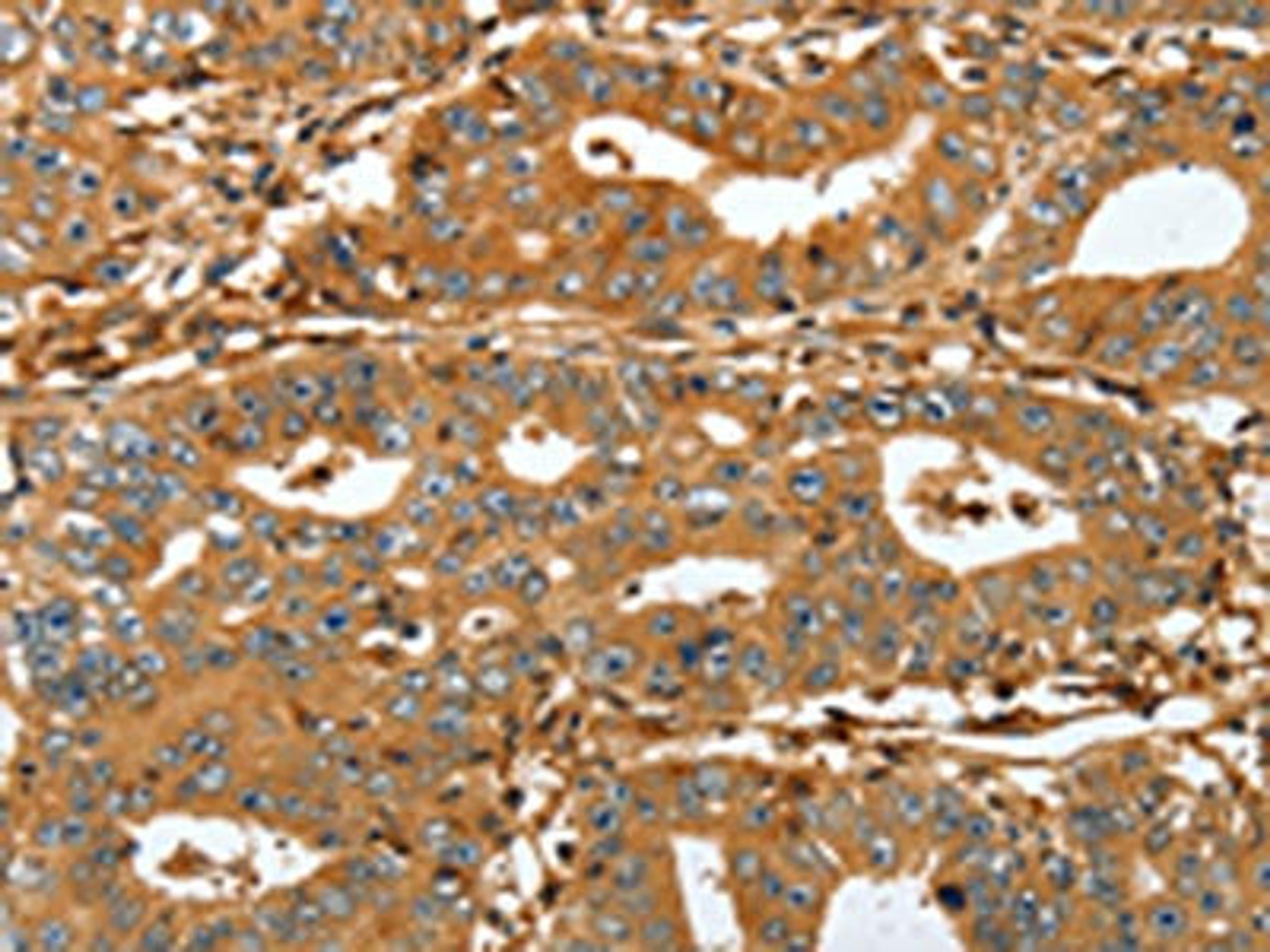 The image on the left is immunohistochemistry of paraffin-embedded Human gastric cancer tissue using CSB-PA968243(RAP1A Antibody) at dilution 1/45, on the right is treated with fusion protein. (Original magnification: ×200)