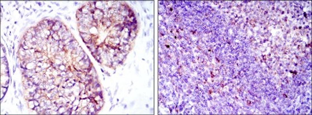 Immunohistochemistry: eEF-2 Antibody (5B6) [NBP2-37620] - Immunohistochemical analysis of paraffin-embedded prostate cancer tissues (left) and tonsil tissues (right) using EEF2 mouse mAb with DAB staining.