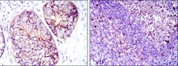 Immunohistochemistry: eEF-2 Antibody (5B6) [NBP2-37620] - Immunohistochemical analysis of paraffin-embedded prostate cancer tissues (left) and tonsil tissues (right) using EEF2 mouse mAb with DAB staining.