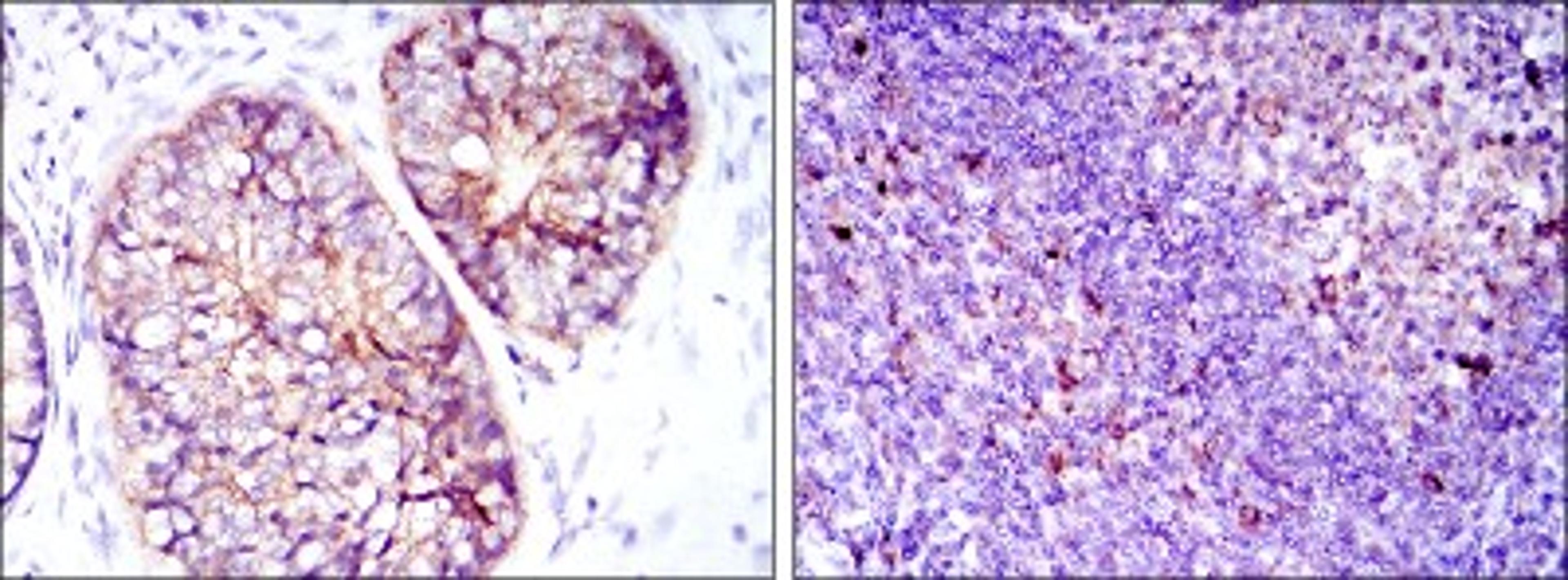 Immunohistochemistry: eEF-2 Antibody (5B6) [NBP2-37620] - Immunohistochemical analysis of paraffin-embedded prostate cancer tissues (left) and tonsil tissues (right) using EEF2 mouse mAb with DAB staining.