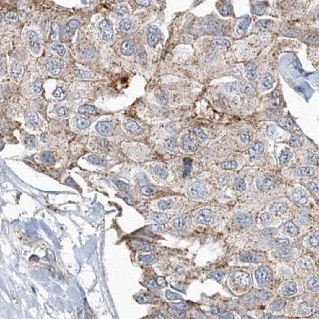 Immunohistochemistry: AASDH Antibody [NBP2-32667] - breast cancer