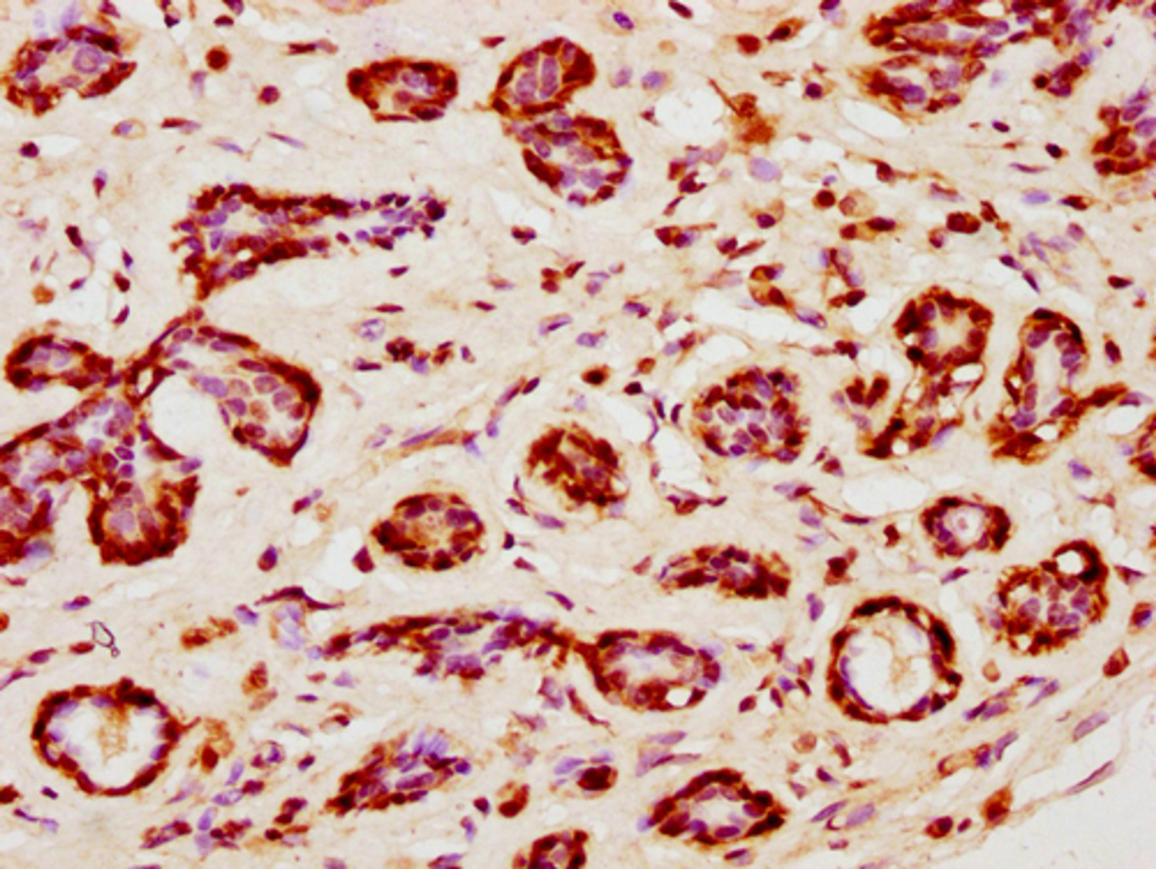 IHC image of CSB-PA010403PA120nsucHU diluted at 1:10 and staining in paraffin-embedded human breast cancer performed on a Leica BondTM system. After dewaxing and hydration, antigen retrieval was mediated by high pressure in a citrate buffer (pH 6.0). Section was blocked with 10% normal goat serum 30min at RT. Then primary antibody (1% BSA) was incubated at 4°C overnight. The primary is detected by a biotinylated secondary antibody and visualized using an HRP conjugated SP system.