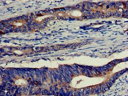 Immunohistochemistry of paraffin-embedded human colon cancer using CSB-PA007554LA01HU at dilution of 1:100