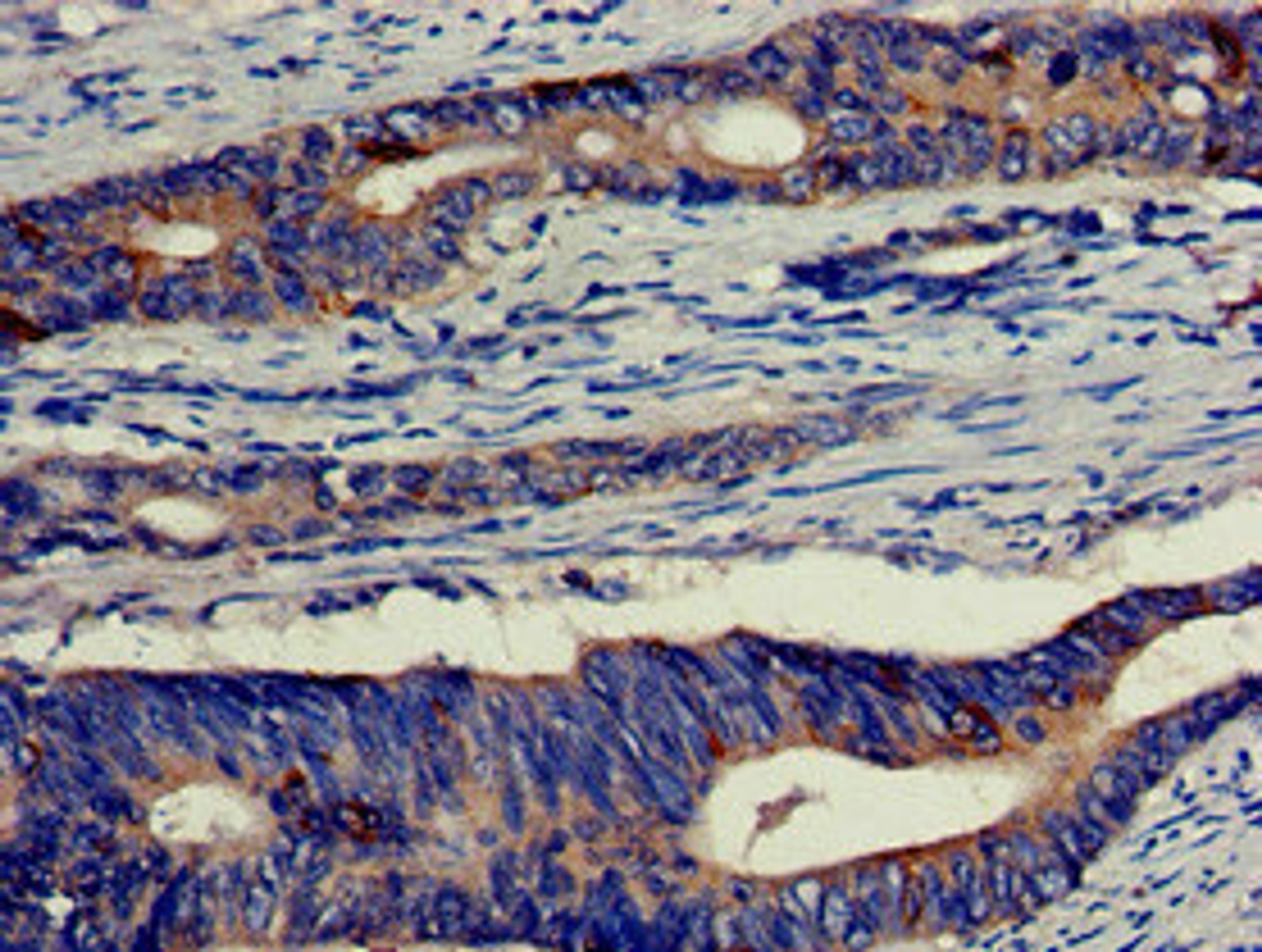 Immunohistochemistry of paraffin-embedded human colon cancer using CSB-PA007554LA01HU at dilution of 1:100