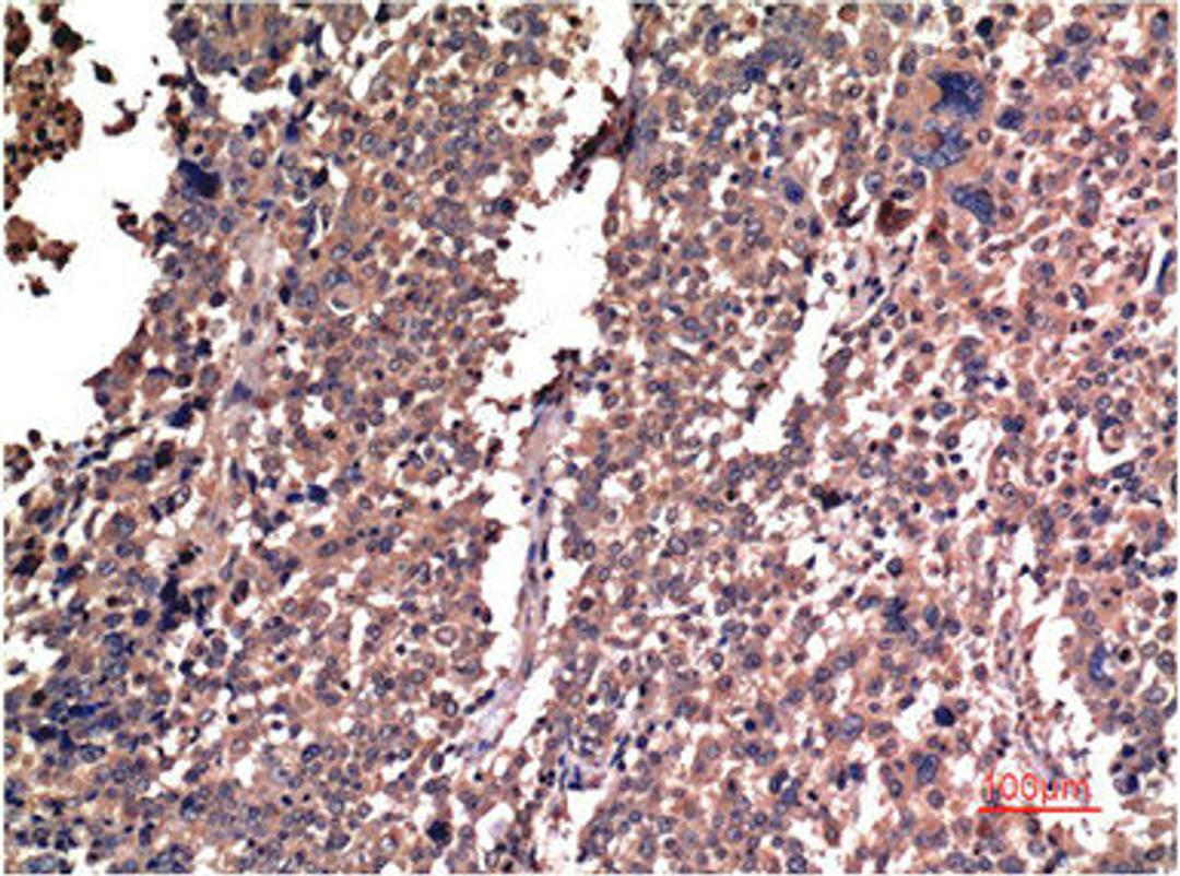 Immunohistochemical analysis of paraffin-embedded Human Lung Carcinoma Tissue using Cyclin B1 Mouse mAb diluted at 1:200.
