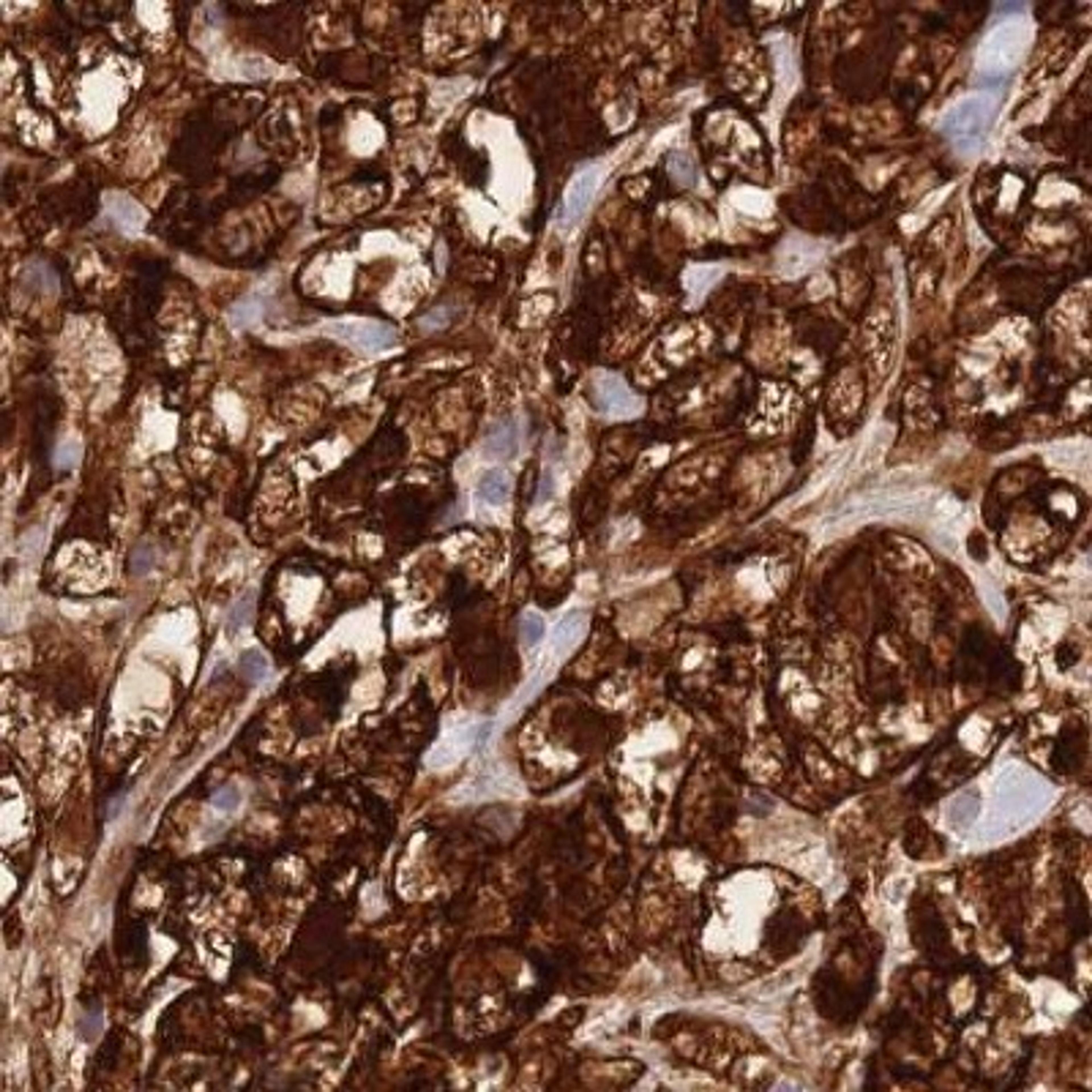 Immunohistochemistry: FBXO46 Antibody [NBP2-31891] - renal cancer