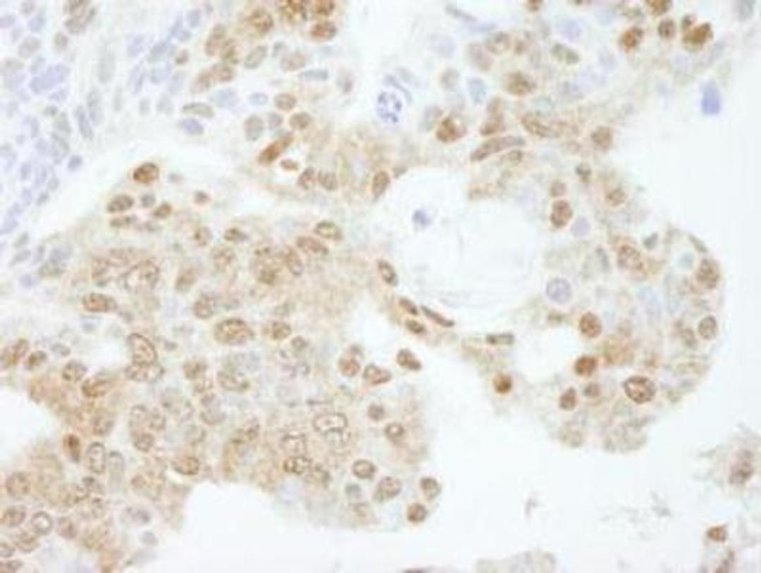 Immunohistochemistry-Paraffin: KPNA3 Antibody [NB100-81650] - FFPE section of human ovarian carcinoma.   Affinity purified rabbit anti-KPNA3 used at a dilution of 1:250.