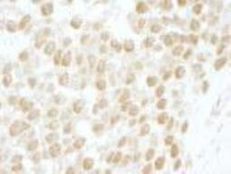 Immunohistochemistry-Paraffin: Casein Kinase 2 beta Antibody [NBP1-06514] - FFPE section of human testicular seminoma.  Affinity purified rabbit anti-CKII beta used at a dilution of 1:250.