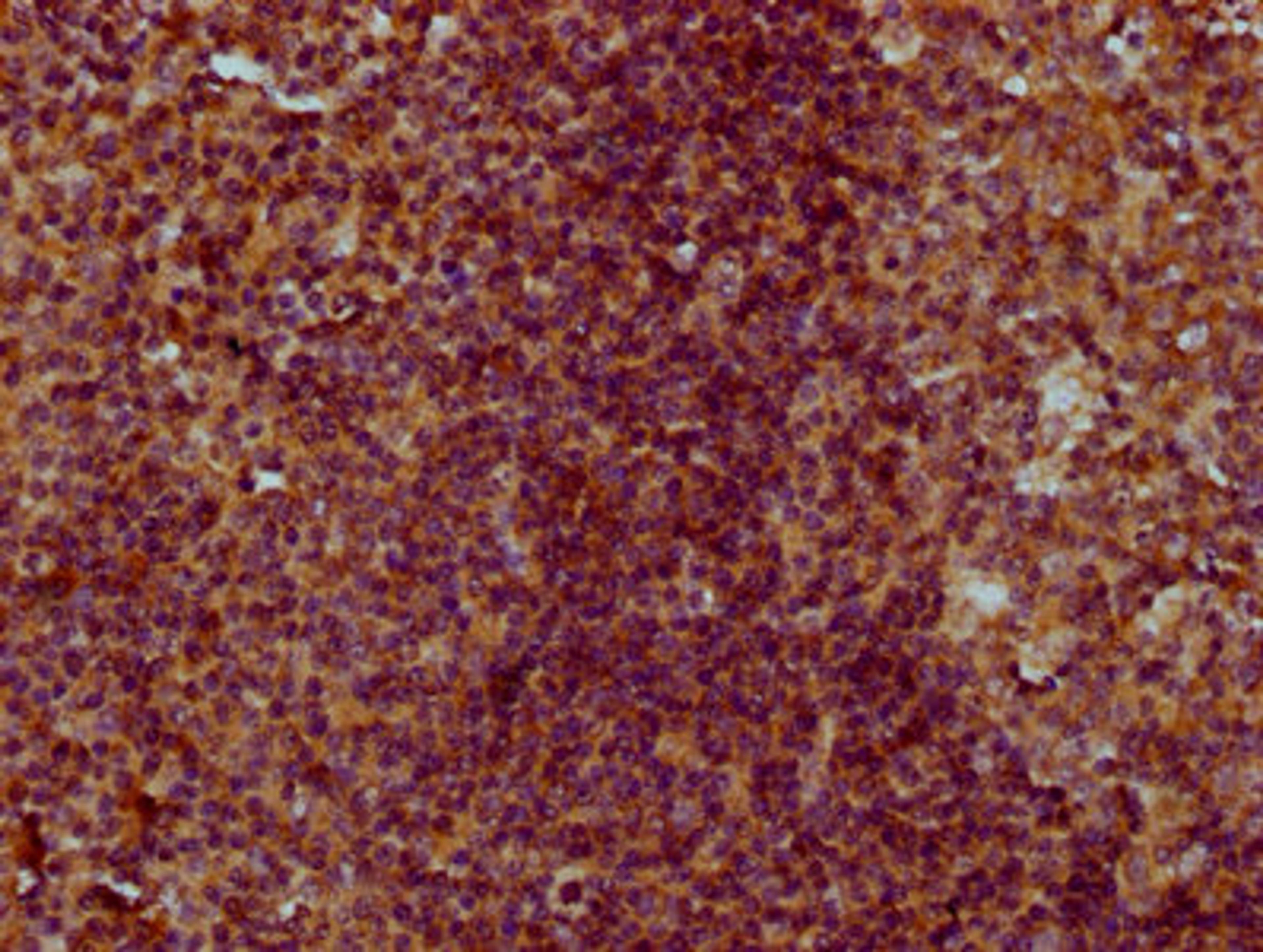 IHC image of CSB-PA005641LA01HU diluted at 1:300 and staining in paraffin-embedded human tonsil tissue performed on a Leica BondTM system. After dewaxing and hydration, antigen retrieval was mediated by high pressure in a citrate buffer (pH 6.0). Section was blocked with 10% normal goat serum 30min at RT. Then primary antibody (1% BSA) was incubated at 4°C overnight. The primary is detected by a biotinylated secondary antibody and visualized using an HRP conjugated SP system.