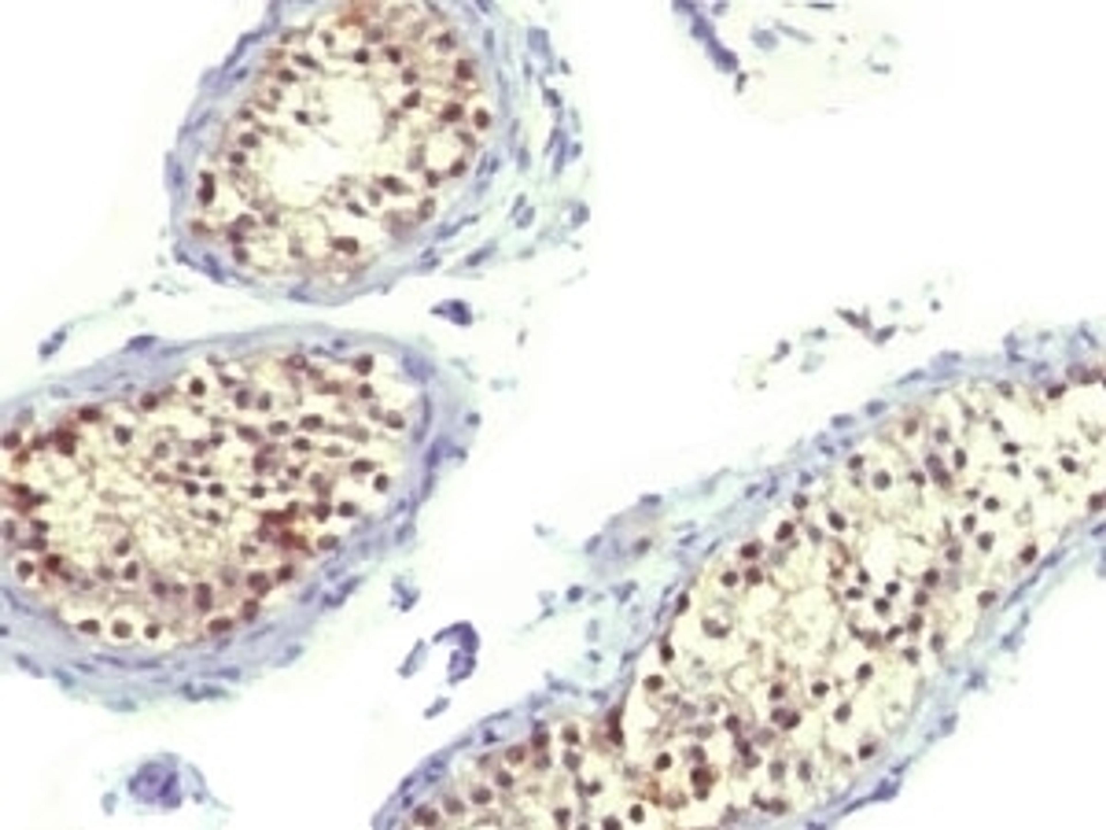 IHC testing of FFPE human testicular carcinoma and Thymidylate Synthase antibody (TYSY9).