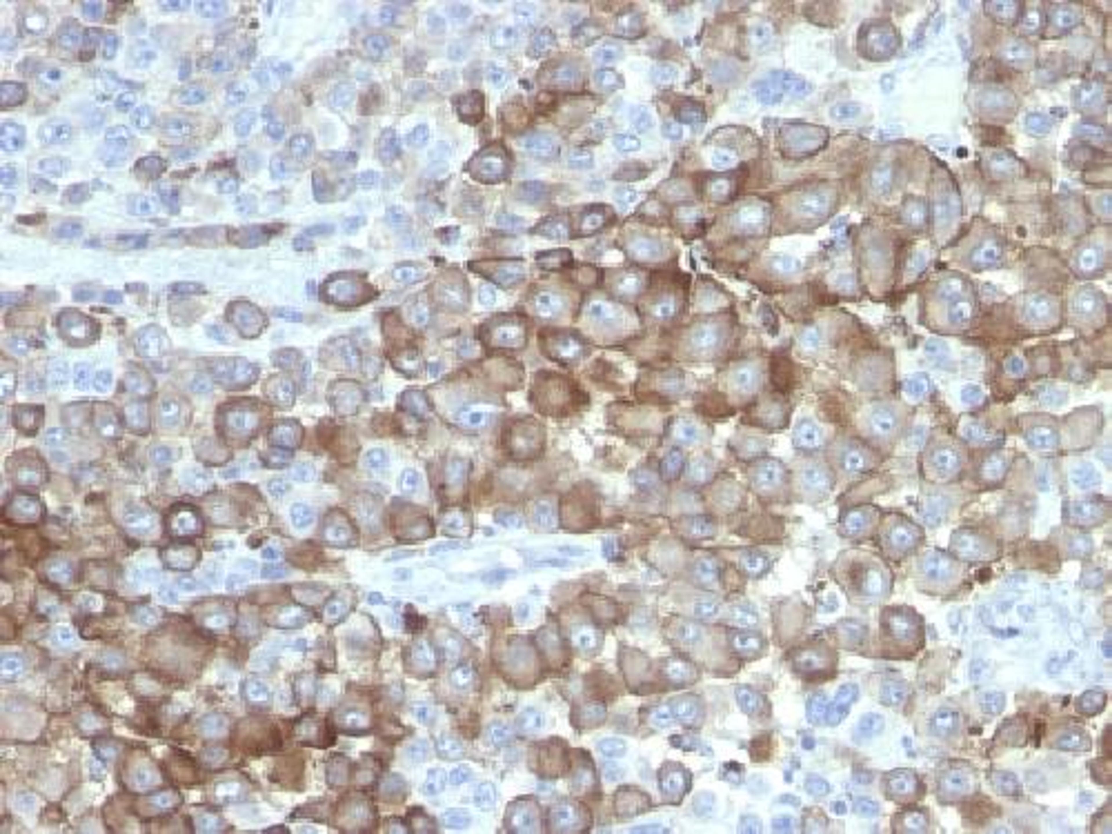 Immunohistochemical staining of human Melanoma tissue using PNL2 antibody