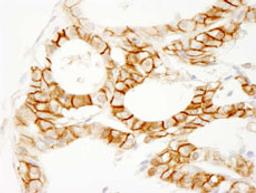 Detection of human beta Catenin by immunohistochemistry.