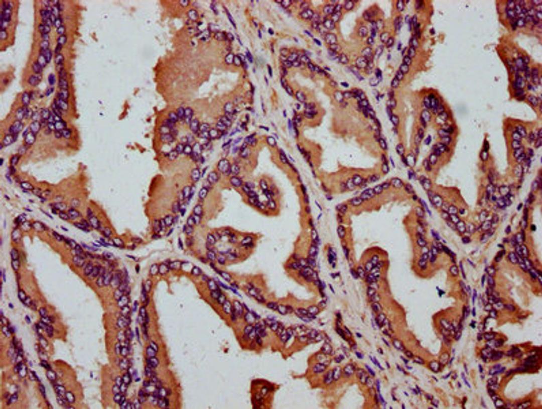 IHC image of CSB-PA741974LA01HU diluted at 1:200 and staining in paraffin-embedded human prostate tissue performed on a Leica BondTM system. After dewaxing and hydration, antigen retrieval was mediated by high pressure in a citrate buffer (pH 6.0). Section was blocked with 10% normal goat serum 30min at RT. Then primary antibody (1% BSA) was incubated at 4°C overnight. The primary is detected by a biotinylated secondary antibody and visualized using an HRP conjugated SP system.