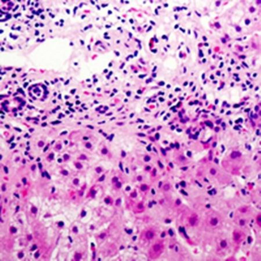 Immunohistochemical analysis of formalin-fixed and paraffin-embedded human liver cancer tissue using Cystatin E/M antibody