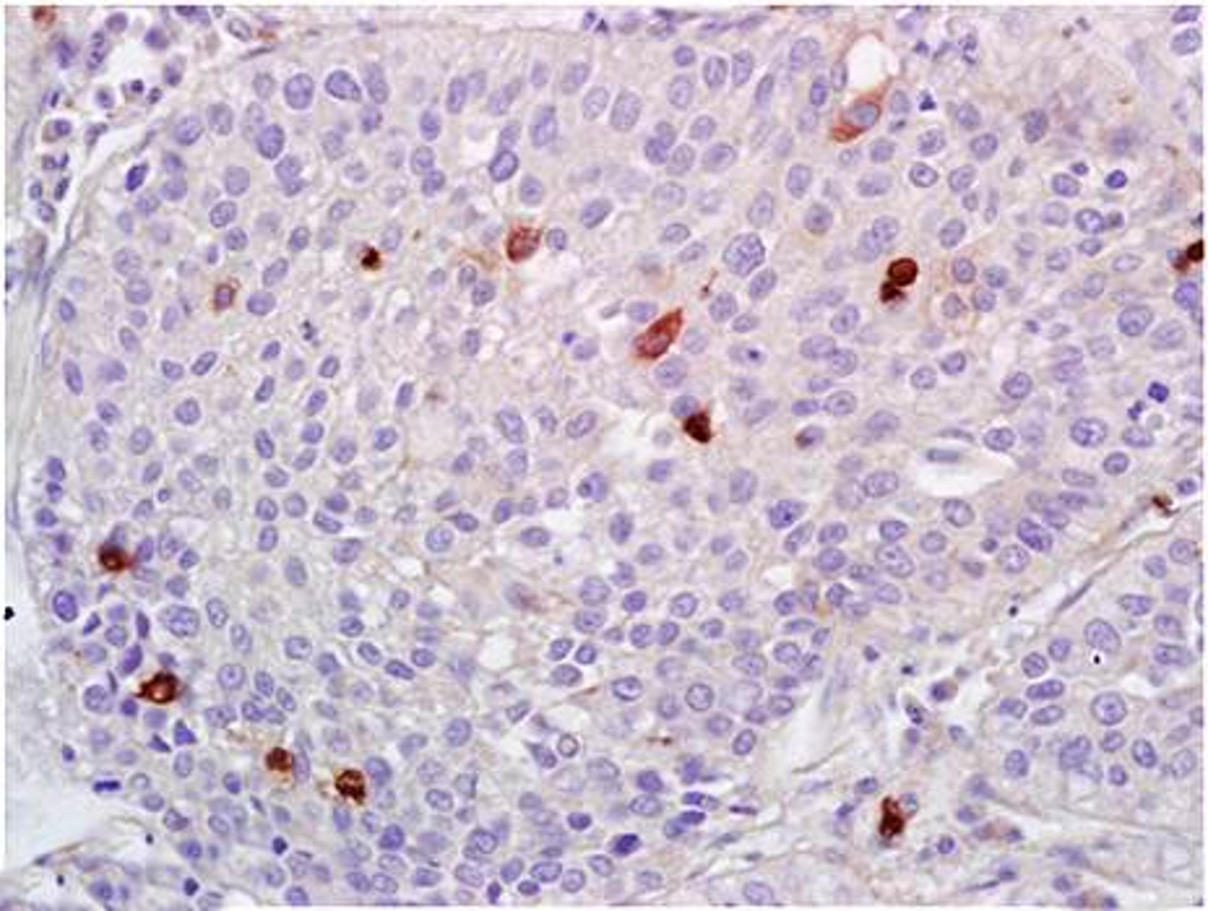 Paraffin-embedded human lung carcinoma tissue fixed with 4% paraformaldehyde. Antigen retrieval by boiling with citrate buffer. Blocking buffer is goat serum (37 degrees for 20 min.). ADAMTS1 antibody at 1:200 dilution with overnight incubation at 4 degre