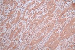 IHC image of CSB-RA892357MA1HU diluted at 1:600 and staining in paraffin-embedded human bladder cancer performed on a Leica BondTM system. After dewaxing and hydration,  antigen retrieval was mediated by high pressure in a citrate buffer (pH 6.0). Section was blocked with 10% normal goat serum 30min at RT. Then primary antibody (1% BSA) was incubated at 4°C overnight. The primary is detected by a Goat anti-Mouse IgG labeled by HRP and visualized using 0.05% DAB.