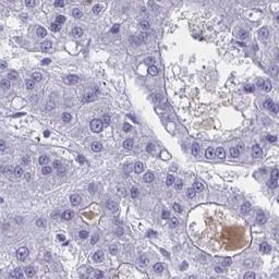 Immunohistochemistry: NANOGNB Antibody [NBP2-32538] - liver cancer