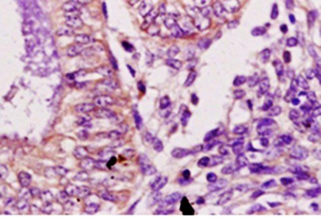 Immunohistochemical analysis of paraffin embedded human endometrium carcinoma tissue using Desmoglein 2 antibody 