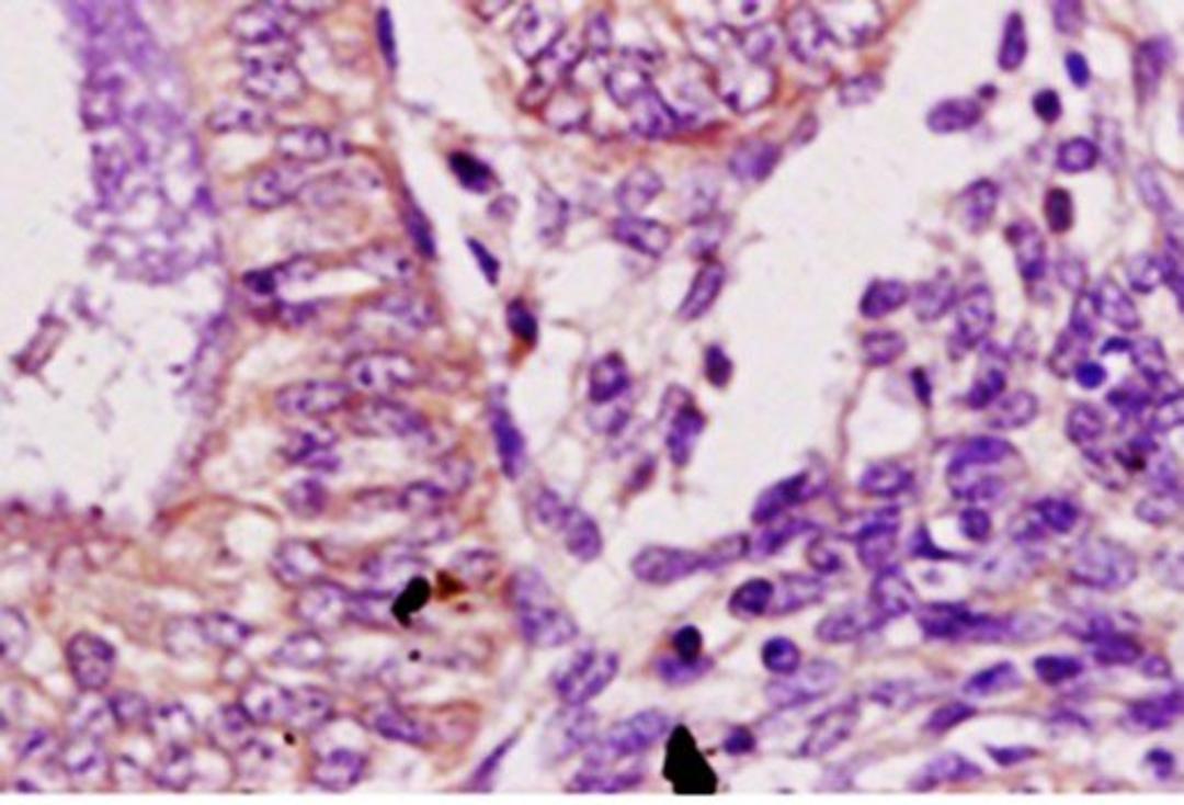 Immunohistochemical analysis of paraffin embedded human endometrium carcinoma tissue using Desmoglein 2 antibody