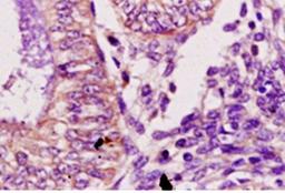 Immunohistochemical analysis of paraffin embedded human endometrium carcinoma tissue using Desmoglein 2 antibody