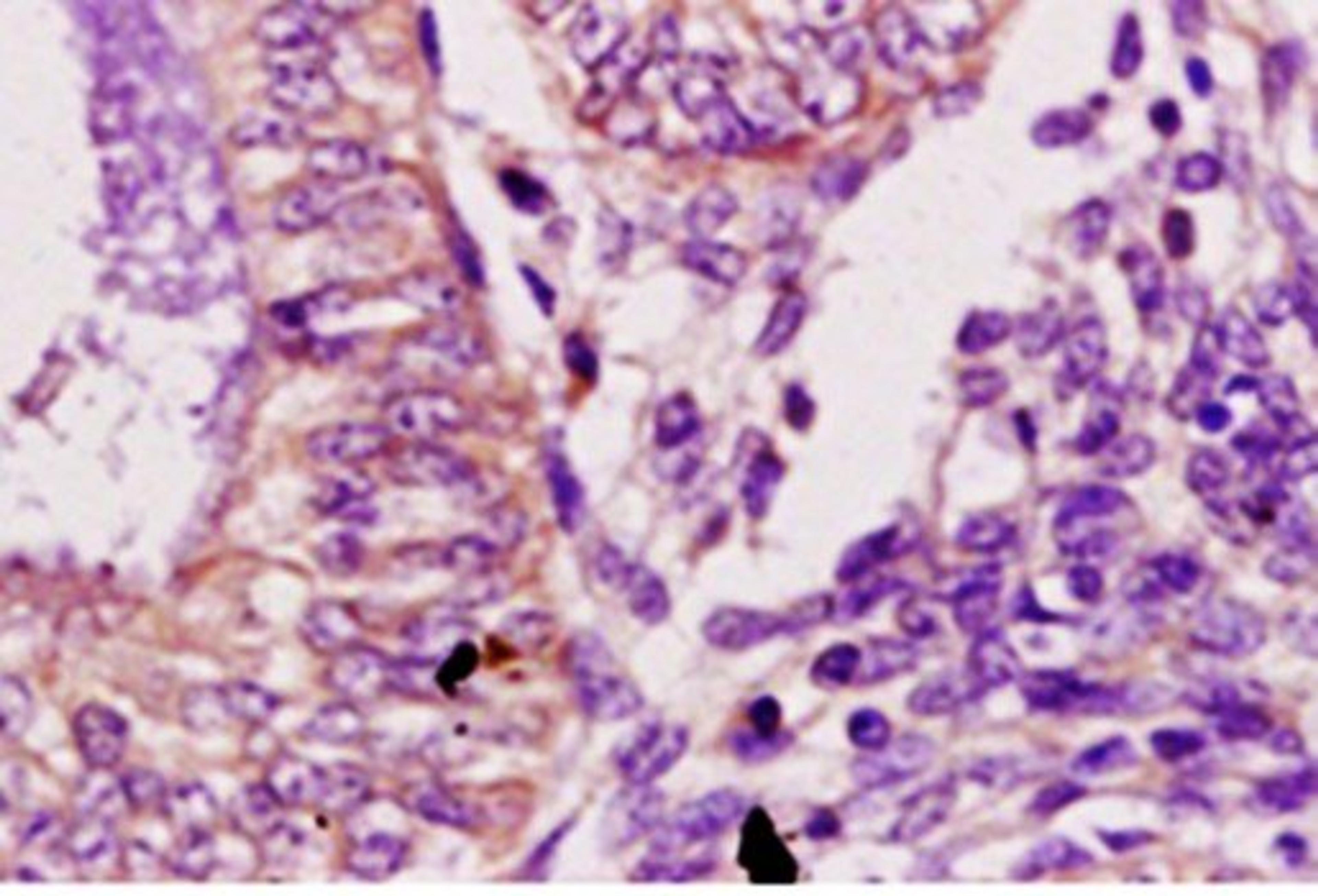 Immunohistochemical analysis of paraffin embedded human endometrium carcinoma tissue using Desmoglein 2 antibody