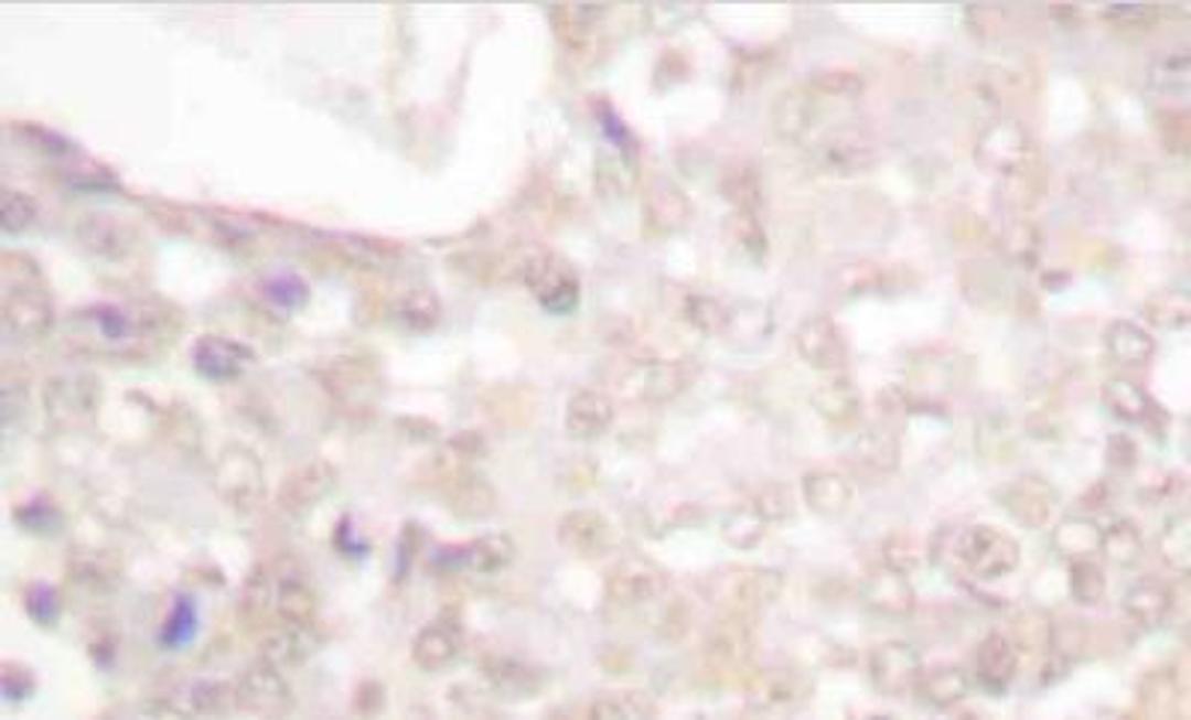 Immunohistochemistry-Paraffin: Smad2 [p Ser467] Antibody [NBP1-51391] - Paraffin-embedded human breast cancer tissue.