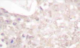 Immunohistochemistry-Paraffin: Smad2 [p Ser467] Antibody [NBP1-51391] - Paraffin-embedded human breast cancer tissue.