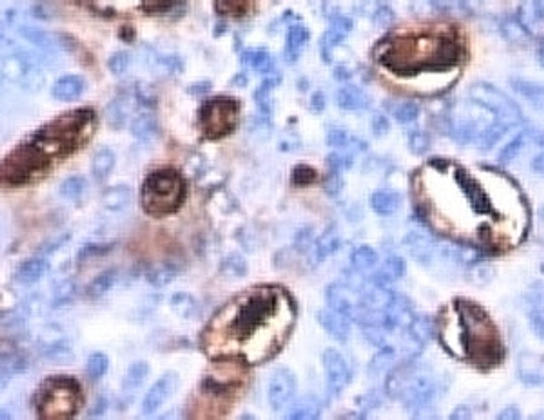 Formalin-fixed, paraffin-embedded human colon carcinoma stained with CA19-9 antibody (SPM588).