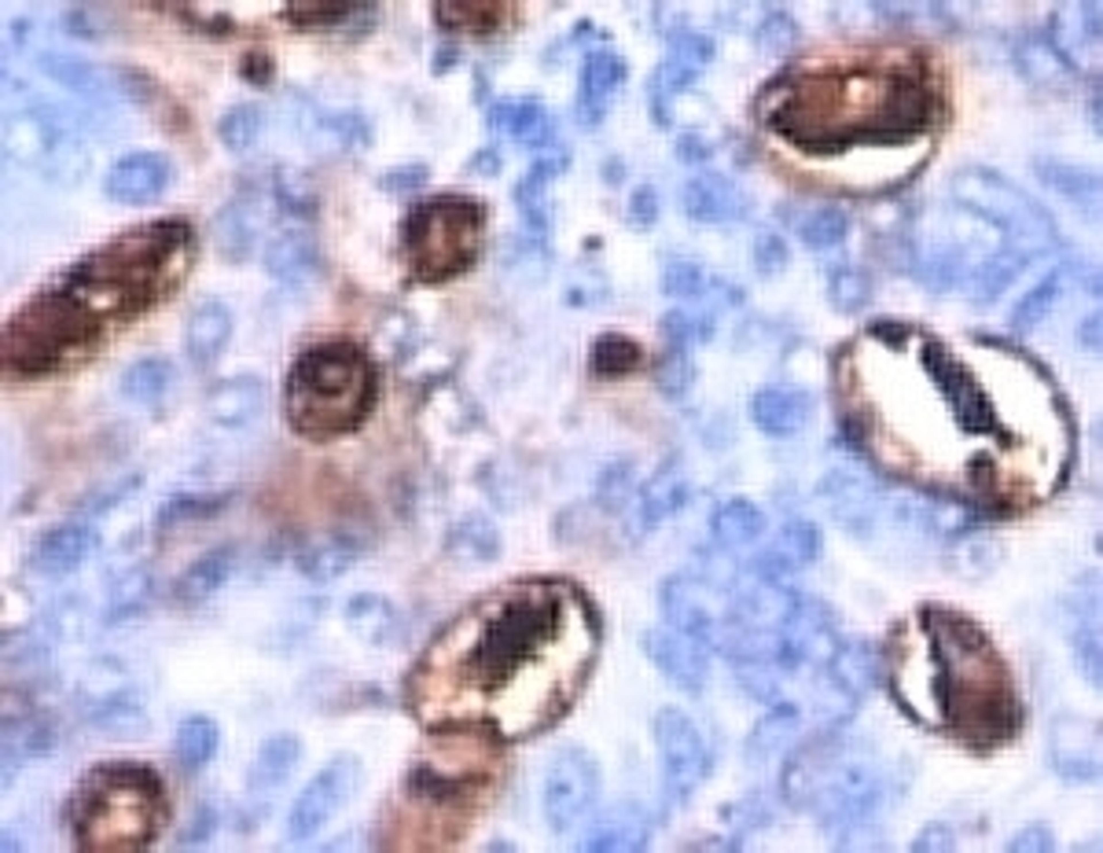 Formalin-fixed, paraffin-embedded human colon carcinoma stained with CA19-9 antibody (SPM588).